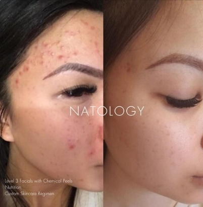 Before after clinicalfacial 10