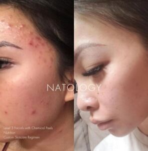 Before after clinicalfacial 2 295x300