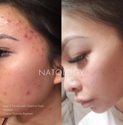 Before after clinicalfacial 2