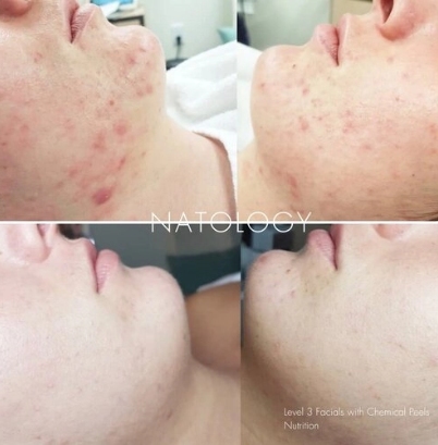 Before after clinicalfacial 3