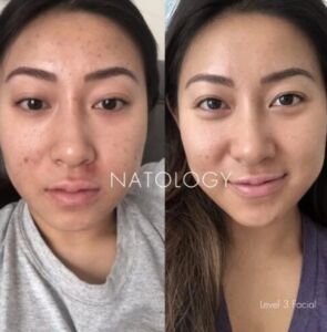 Before after clinicalfacial 6 295x300