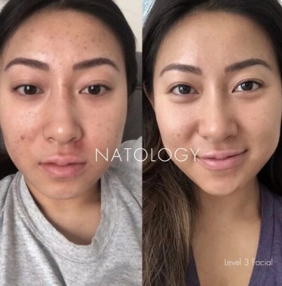 Before after clinicalfacial 6