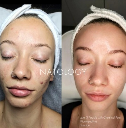Before after clinicalfacial 6 1