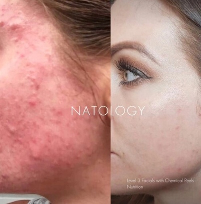 Before after clinicalfacial 7