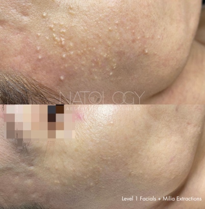 Level 1 facial 1