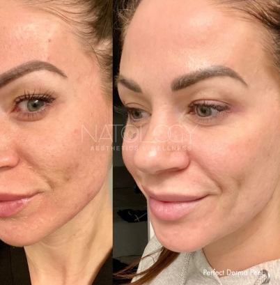 Chemical peels 2