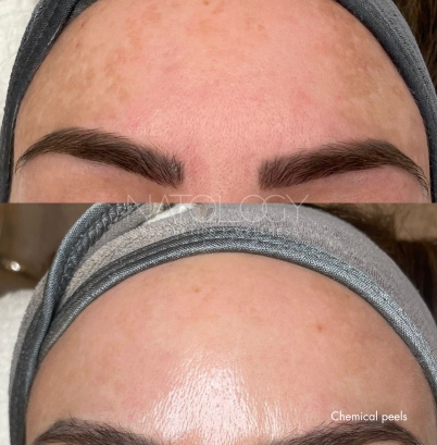 Chemical peels 3