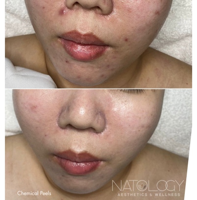 Chemical peels 4