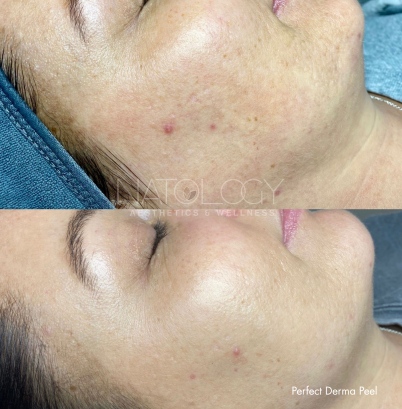 Chemical peels