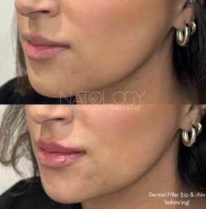 Dermal filler 4 295x300