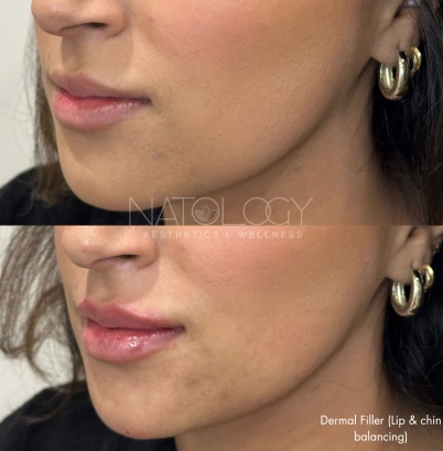 Dermal filler 4