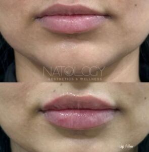 Dermal filler 5 295x300