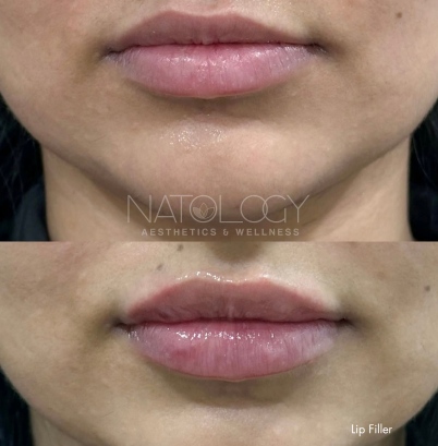 Dermal filler 5
