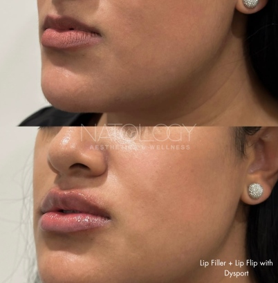 Dermal filler 6