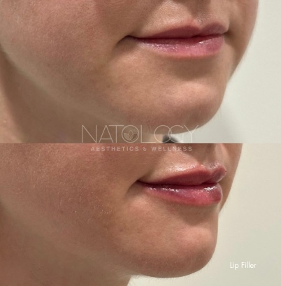 Dermal filler 7