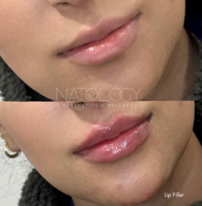 Dermal filler 8