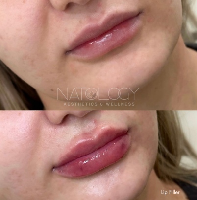Dermal filler 9