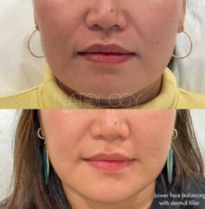 Dermal fillers 1 295x300