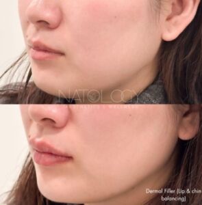 Dermal fillers 2 295x300
