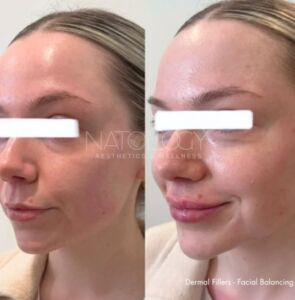 Dermal fillers 3 295x300