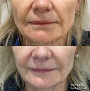 Dermal fillers 5 295x300