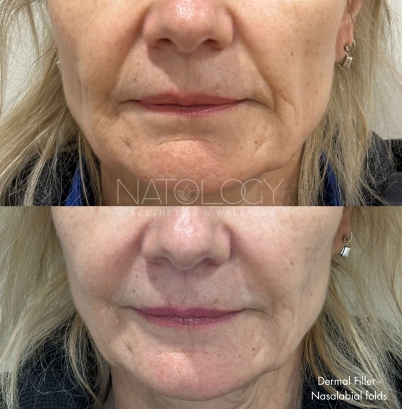 Dermal fillers 5
