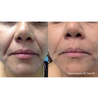 Facelift 1