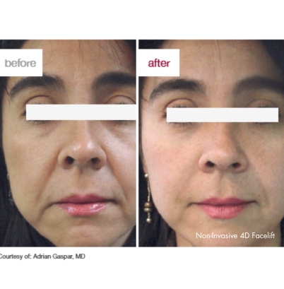 Facelift 2
