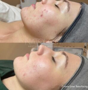Laser 1 295x300