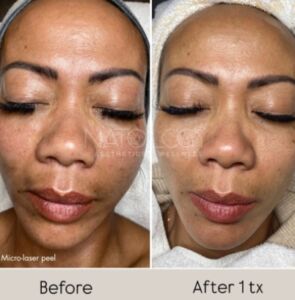 Laser 6 1 295x300