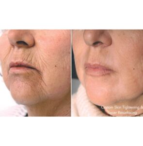 Laser 7 295x300