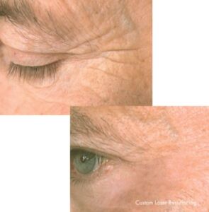 Laser 8 295x300