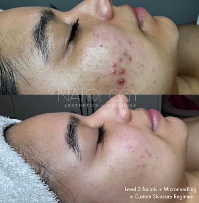 Level 3 facials 7