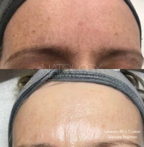 Photo rejuvenation 1 295x300