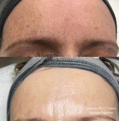 Photo rejuvenation 1