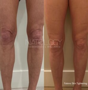 Skin tightening 1 295x300