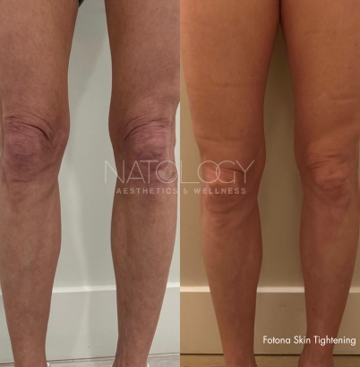 Skin tightening 1