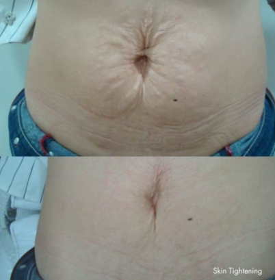 Skin tightening 3