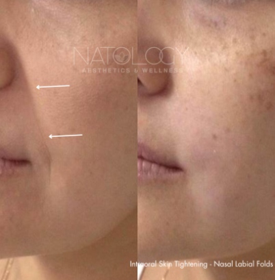 Skin tightening 4