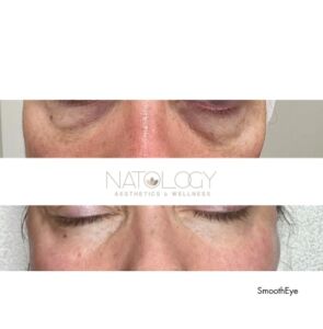 Smooth eye 295x300