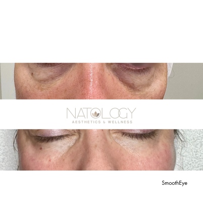 Smooth eye