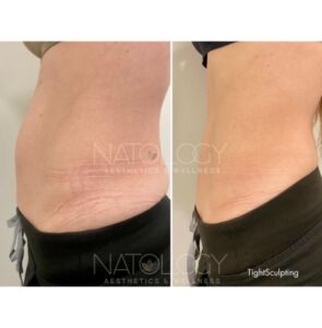 Tightsculpting 1 295x300