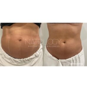 Tightsculpting 2 295x300