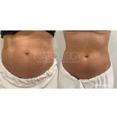Tightsculpting 2