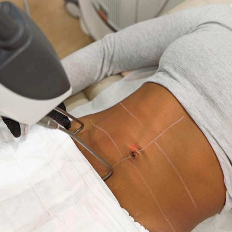 Woman doing tightsculping treatment natology
