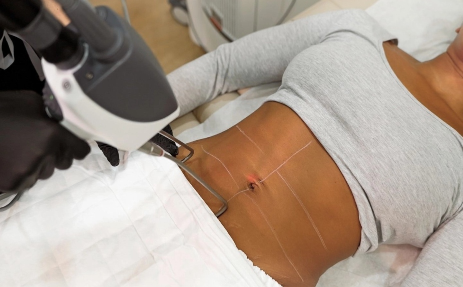 Woman doing tightsculping treatment