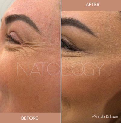 Wrinkle relaxer 1