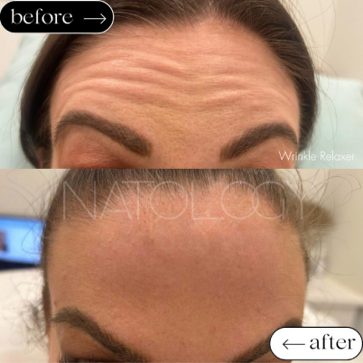 Wrinkle relaxer 2