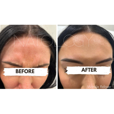 Wrinkle relaxer 3