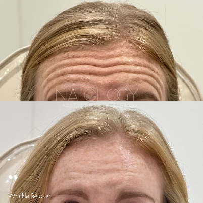 Wrinkle relaxer 4